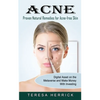 Acne: Proven Natural Remedies for Acne-free Skin (Learn About the Most Recent Updated Natural Acne) - Paperback